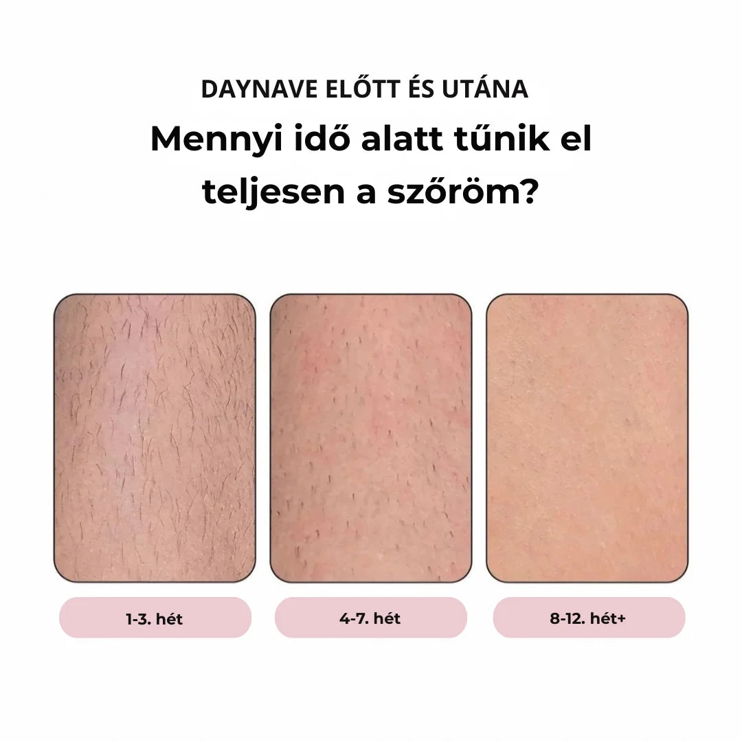 Daynava™ IPL Epilátor (HU)