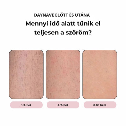 Daynava™ IPL Epilátor (HU)
